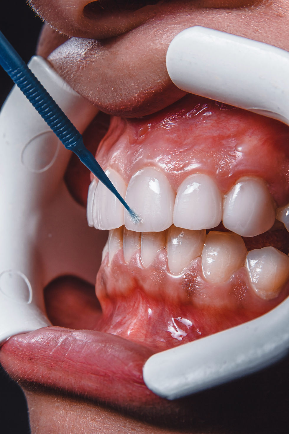Close-up of teeth whitening procedure