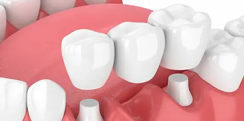 Animation showing a dental bridge being placed and removed at Rovi Smile Center