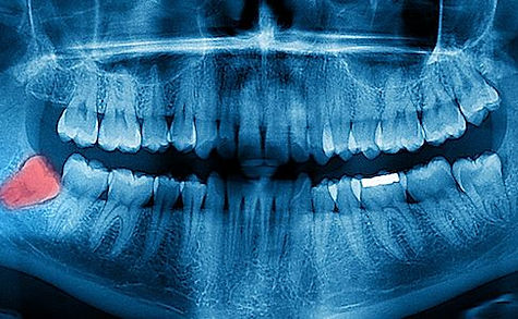 are_dental_x_rays_safe_greenfield_wi_uh3jxz.jpeg