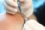 Nasrin Sapphire Percutaneous Method.jpg