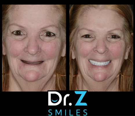 AOX - Full Mouth Reconstruction