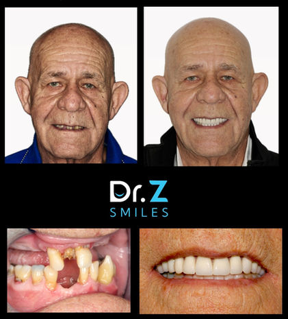 AOX - Full Mouth Reconstruction