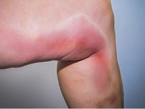 Você sabe a diferença entre flebite e erisipela?