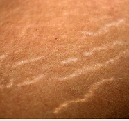Stretch Marks prior just befor stretch mark tattoo treatment