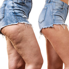 Cryo T-Shock vs. Endosphere for Cellulite: Which is Best in 2026?