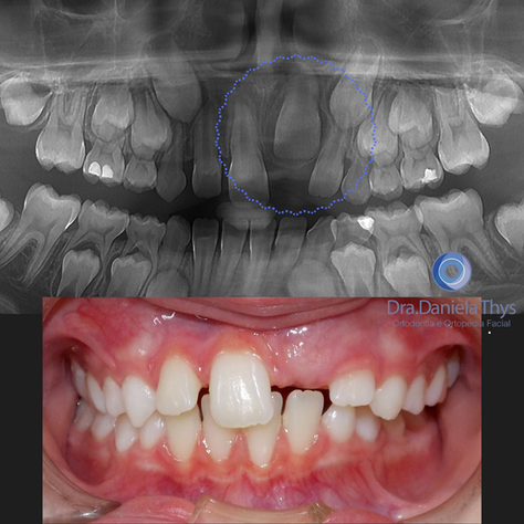 Incisivo Central Impactado