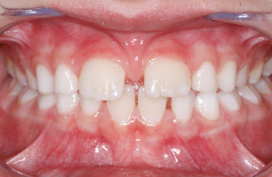 Imagem dos dentes em oclusão apresentando diastema entre os incisivos centrais superiores