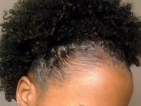 Traction Alopecia: Causes, Prevention and Treatment for Hair Loss