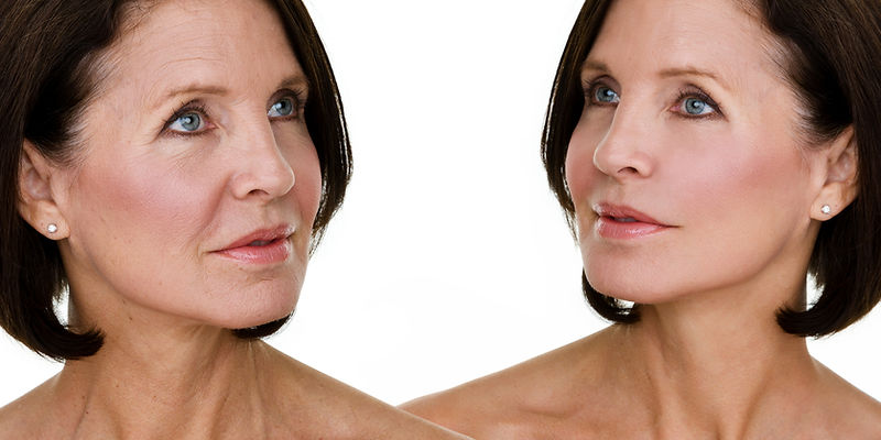 Botox and dermal filler results