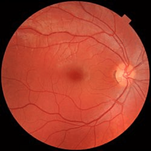 OCT Eye Screening