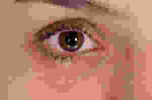 watery eyes