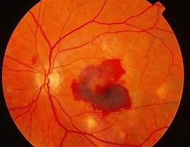 Wet amd