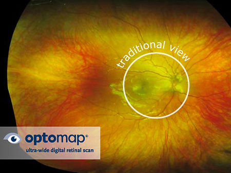 optomap retinal scans