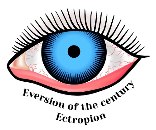 My eyelid turns outwards - Why are my eyelids turning outwards?