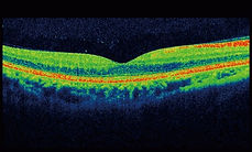 Retinal Image Analysis