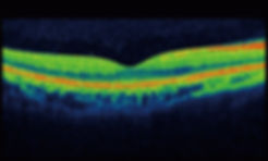 Retinal Imaging