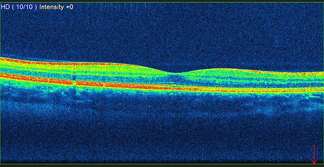3D RETINAL SCANNING