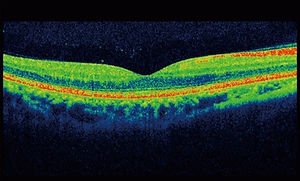 OCT Scan Image