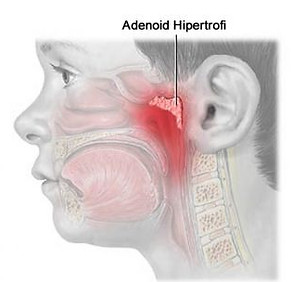 adenoid hip.jpg