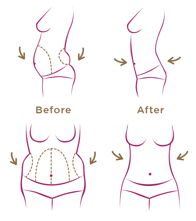 Tummy tuck 2.webp