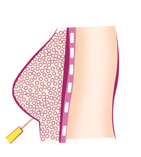 COVETTE-website-plastic-surgery-Breast-fat-grafting-diagram3.webp