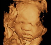 3D baby scan