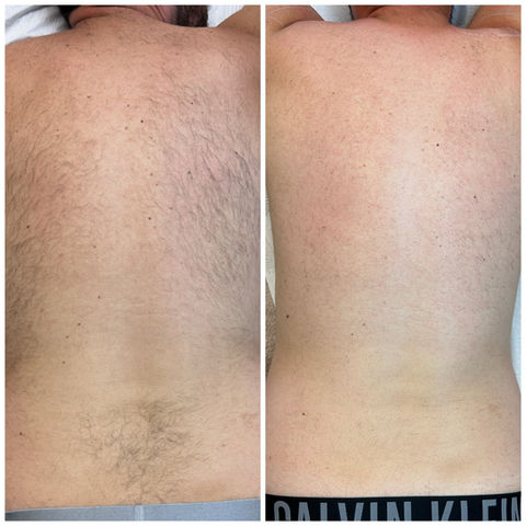 Male Back Hair Removal Results.jpeg