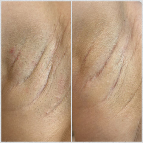 Underarm Hair Removal Results.jpeg