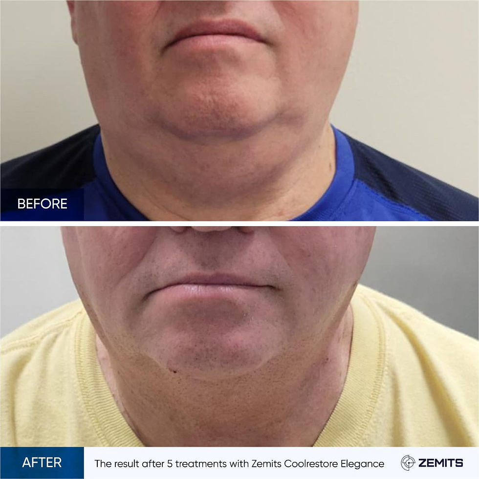 The result after 5 treatments with Zemits Coolrestore Elegance