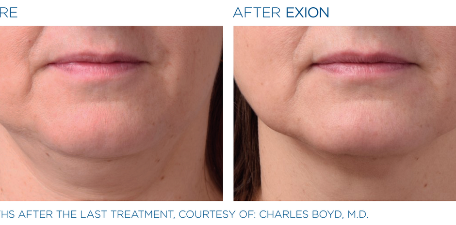 BTL Exion - Before & After Photo