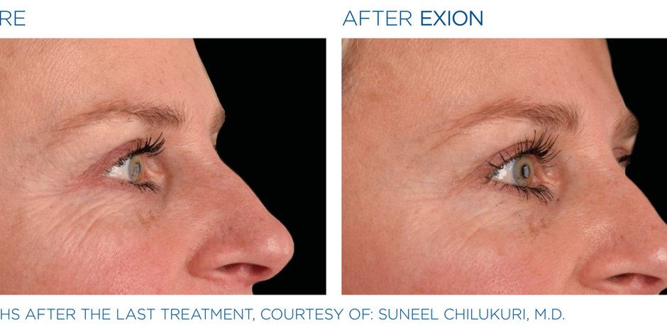 BTL Exion - Before & After Photo