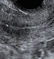 UTERUS ULTRASOUND