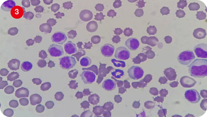 Imagen 3 y 4. Frotis sanguineo teñido con Diff-Quick, aumento 100x. Presencia de linfocitos displásicos con presencia de cromatina nuclear reticulada, anisocariosis, anisocitosis, núcleos hendidos
