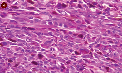 Figura 4. Histopatología de melanoma cutáneo de axila, con H y E (100X).