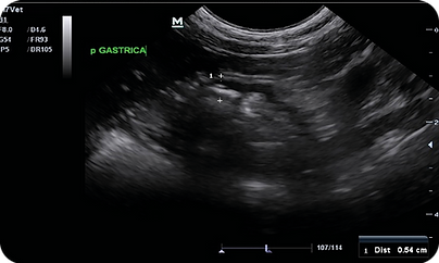 Imagen 2. Vista transversal, pared intestinal engrosada (1 cm), los rangos normales varían desde 2.2 mm en duodeno y yeyuno, 2.8 mm en íleon y 1.5 mm en ciego y colón.
