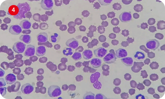 Imagen 3 y 4. Frotis sanguineo teñido con Diff-Quick, aumento 100x. Presencia de linfocitos displásicos con presencia de cromatina nuclear reticulada, anisocariosis, anisocitosis, núcleos hendidos