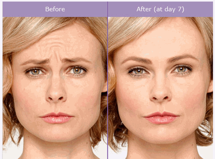 botox-wypełniacze-efekty-medycyna-estetyczna-laserowe-love-racibórz