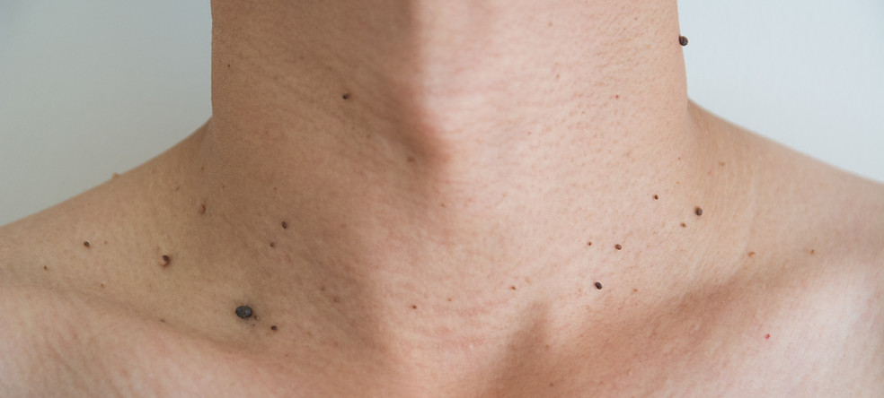 Mole or wart on the men skin.jpg