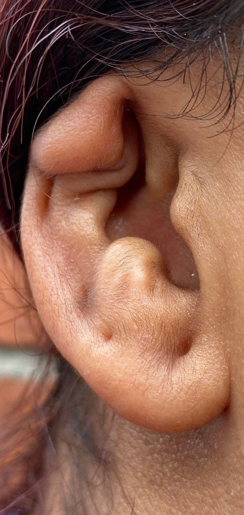 Cartilage Collapse