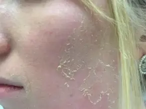 Retinol Peeling Skin (Causes, Healing Process & When To Stop)