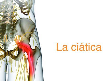 La ciática