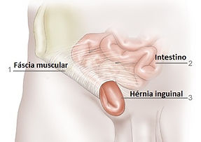 Hernia inguinal