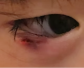 霰粒腫の症例06