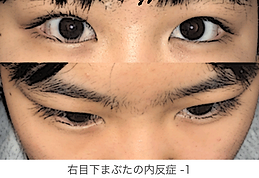 右目の下まぶたの内反症 - 1.png