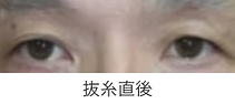 眉毛下皮膚切除術_抜糸直後.png