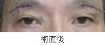 眉毛下皮膚切除術_術直後.png