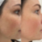 result one treatment warm plasma facial treatment