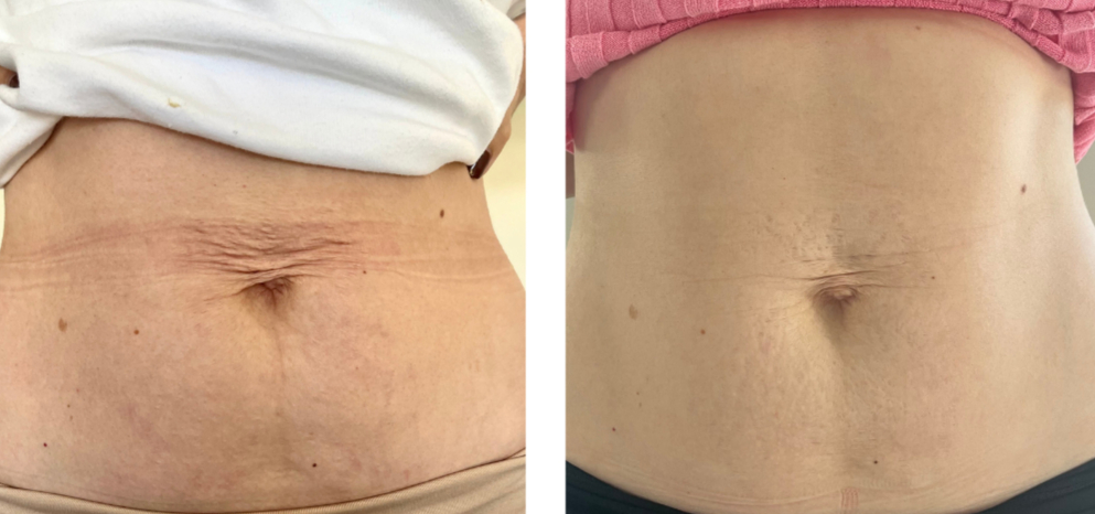 Skin tightening treatments Newcastle