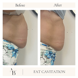 before after Fat cavitation Newcastle aspects of beauty