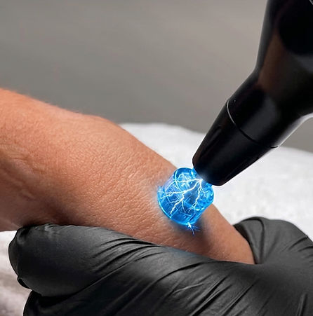 plasma microneedling_edited.jpg